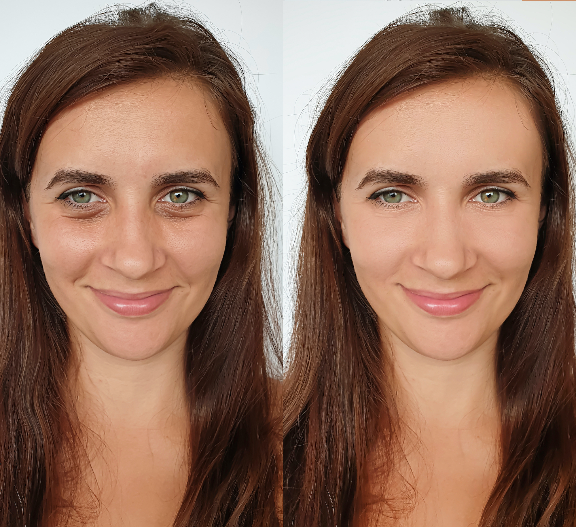 Before-After-Eyelift-Beauty-Shot