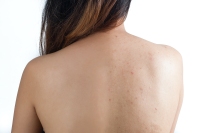 Before-After-Body-Acne-Stock-Photo