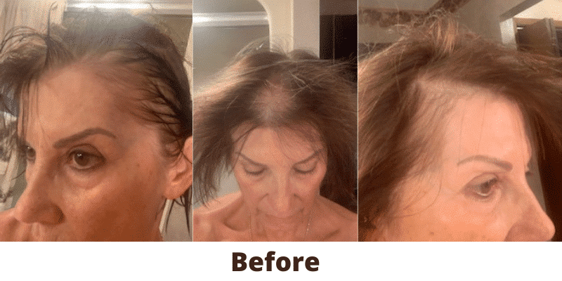 kiierr laser cap testimonial before:after treatment image - older woman