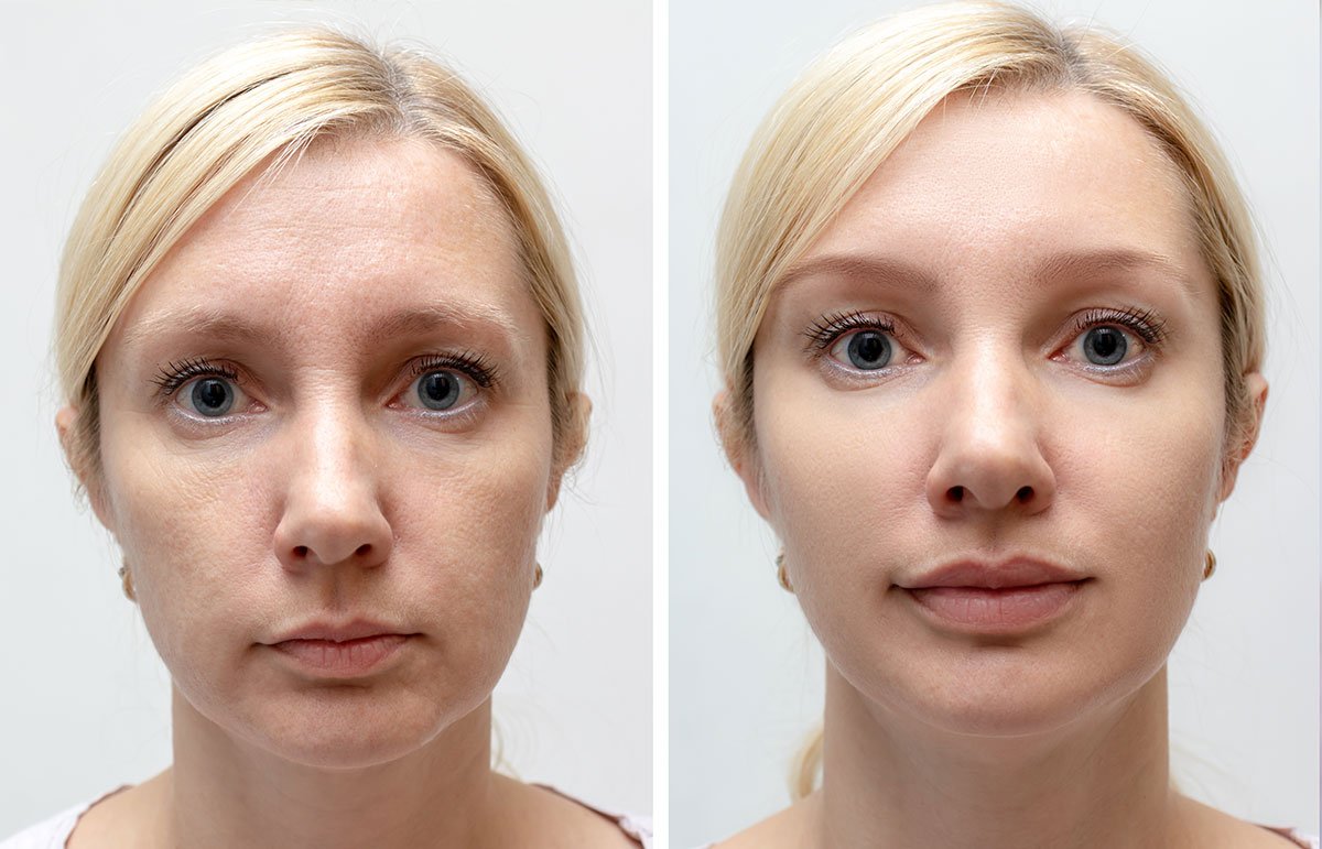 Stemuderm Before After