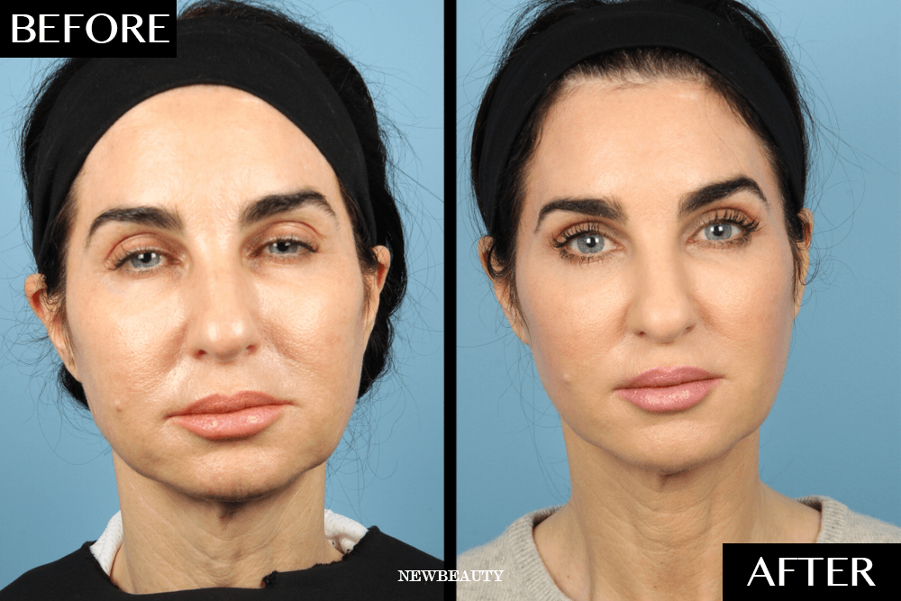 The Nonsurgical Procedure That Gave This 52-Year-Old Woman the Look of a Full Facelift featured image